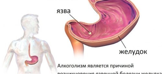 Влияние алкоголя на жкт