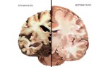 Отличия мозга алкоголика от мозга здорового человека